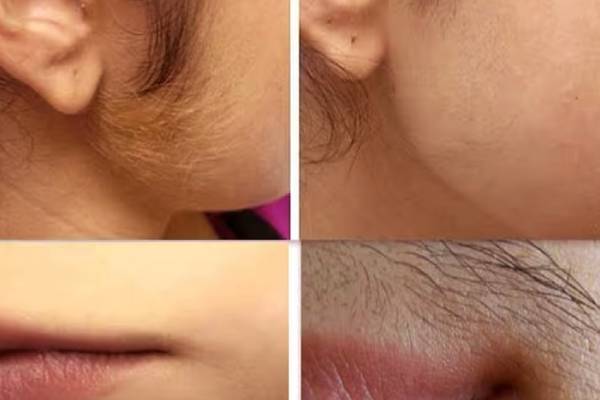 பெண்களுக்கு முகத்தில் மீசை தாடி வளர்வது ஆபத்தா? | Dangerous For Women To Grow A Mustache And Beard