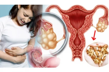 பி.சி.ஓ.எஸ் ஏற்பட காரணம் என்ன? அறிகுறிகளை கண்டறிவது எப்படி ?