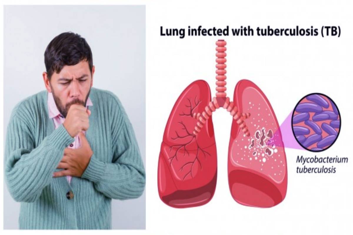 காசநோயின் ஆரம்ப அறிகுறிகள் என்னென்ன? இதை மட்டும் புறக்கணிக்காதீங்க | What Are The Early Symptoms Of Tuberculosis