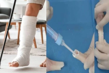 எலும்பு முறிவை 3 நிமிடத்தில் சரி செய்துவிடலாம் - சீன விஞ்ஞானிகளின் புதிய கண்டுபிடிப்பு