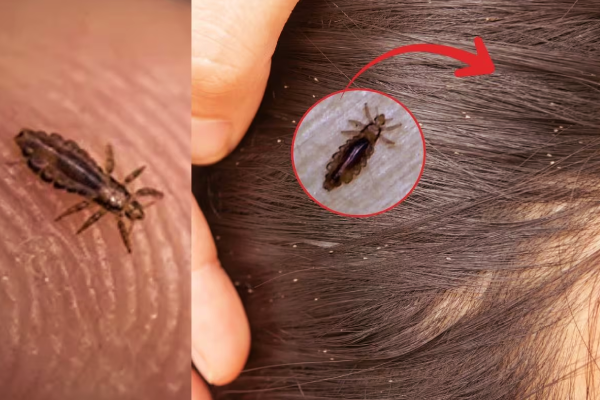 தலையில் இருக்கும் பேன் தொல்லைக்கு - பூண்டு இருந்தா இதனுடன் அரைத்து பூசுங்க | Home Remedies To Get Rid Of Head Lice Tamil