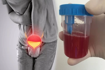 சிறுநீருடன் இரத்தம் வருகிறதா? அப்போ இந்த நோய் இருக்கு... ஜாக்கிரதை