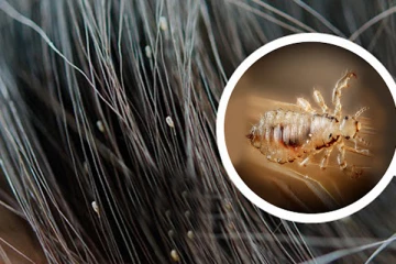 பேன், ஈறு, பொடுகு  தொல்லையா? இதை தேய்த்த 2 மணி நேரத்தில் மொத்தமாக எல்லாம்  உதிர்ந்து விடுமாம்!