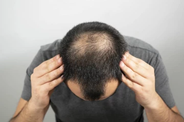 வழுக்கை தலையில் முடி வளர வேண்டுமா? இதோ சில எளிய வழிகள்