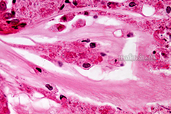 ஈரலில் கெட்ட நீர் தேங்கியிருந்தால் உயிருக்கு ஆபத்து! இந்த  அறிகுறி இருந்தால் உடனே மருத்துவரை நாடுங்கள் | Pulmonary Edema Symptoms In Tamil
