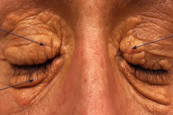 முகத்தில் கொலஸ்ட்ரால் அறிகுறிகள்: உங்கள் கண்களுக்கு கீழ் இப்படி உள்ளதா? | Cholesterol Symptoms On The Face