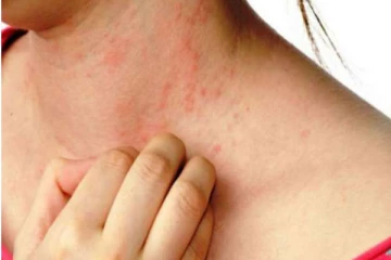 சொரியாசிஸ் அதிகரிக்கும் காரணம்! என்ன செய்வது?