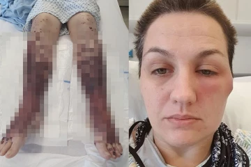 ஆஸ்ட்ராசெனகா தடுப்பூசி போட்டுக்கொண்டபின் பெண்ணுக்கு நேரிட்ட பயங்கரம்: கால்களை இழக்க நேருமோ என அச்சம்