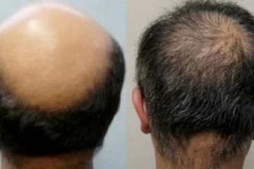 வழுக்கை தலையில் முடி வளர வேண்டுமா? எளிதான மற்றும் இயற்கையான இந்த முறையை செய்தால் போதுமே