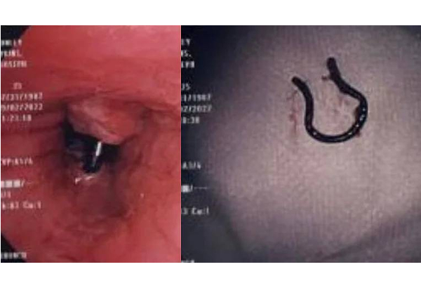 5 ஆண்டுக்கு முன் தொலைந்த மூக்கு வளையம் - ஸ்கேன் செய்து பார்த்த மருத்துவர்களுக்கு காத்திருந்த அதிர்ச்சி! | Man Found Nose Ring After Five Years In His Lung