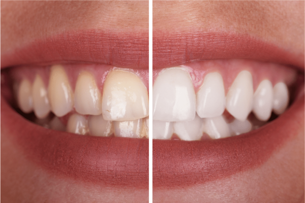 பற்களின் மஞ்சள் கறைக்கு காரணமாகும் பழக்கங்கள் - விளக்கம் இதோ | Habits That Cause Yellow Teeth பற்களின் மஞ்சள் கறைக்கு காரணமாகும் பழக்கங்கள் - விளக்கம் இதோ | Habits That Cause Yellow Teeth