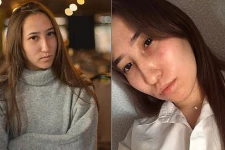 அழகிய இளம்பெண்ணைக் கடித்துக் குதறிய 10 நாய்கள்: அடையாளம் காண முடியாத அளவுக்கு மாறிப்போன முகம்