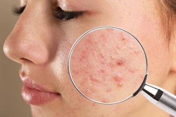 முகப்பரு இல்லாமல் சருமம் பளபளக்கனுமா? இதில் ஒன்றை ட்ரை பண்ணி பாருங்க போதும்