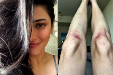 ஸ்ருதிஹாசனுக்கு என்னாச்சு.. காலில் காயங்களுடன் வெளியான புகைப்படம்