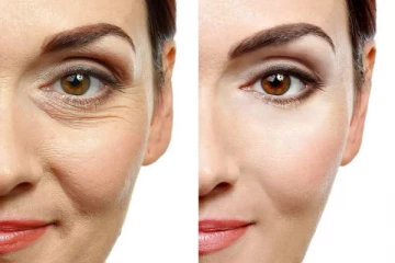 முகச்சுருக்கமா? இனி கோபப்படாதீங்க...