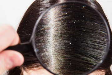 பொடுகு பிரச்சினையை தீர்க்கும் வீட்டு வைத்தியம் - என்ன செய்யலாம்?