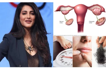 ஸ்ருதிஹாசனுக்கு வந்துள்ள நோய்! அறிகுறிகள் என்னென்ன? எப்படி சரிசெய்வது?