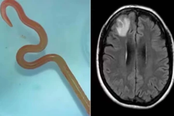 பெண்ணின் மூளையில் 8 செ.மீ அளவில் புழு... எப்படி சென்றது தெரியுமா?