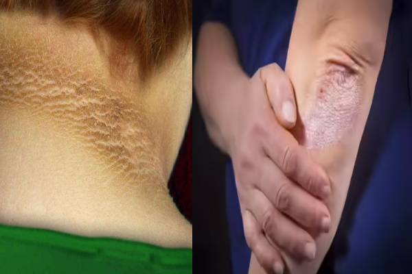 நீரிழிவு நோயின் எச்சரிக்கை அறிகுறிகள் என்னென்ன தெரியுமா? அலட்சியப்படுத்தினால் ஆபத்து! | What Are Diabetes Warning Signs On Your Skin நீரிழிவு நோயின் எச்சரிக்கை அறிகுறிகள் என்னென்ன தெரியுமா? அலட்சியப்படுத்தினால் ஆபத்து! | What Are Diabetes Warning Signs On Your Skin