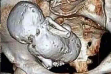 73 வயது பாட்டியின் வயிற்றில் 35 ஆண்டுகளாக வளர்ந்த குழந்தை: பின்னணியில் பகீர் காரணம்