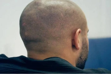 வழுக்கை தலையை உண்டாக்கும் 5 எண்ணெய்கள்