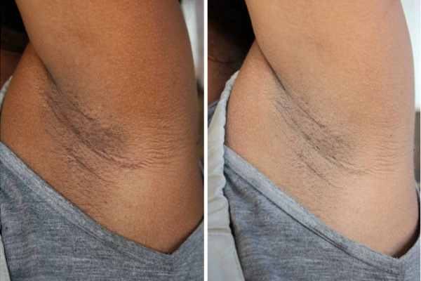 அக்குள் கருப்பா இருக்கா...நொடியில் வெள்ளையாக்க இந்த அற்புத பொருள் போதும்! இதோ சூப்பர் டிப்ஸ் | Diy Masks To Lighten Your Underarms