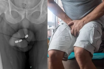 அவுஸ்திரேலிய முதியவரின் பிறப்புறுப்பில் சிக்கிக்கொண்ட 3 பட்டன் பேட்டரிகள்: மருத்துவர்கள் செய்தது என்ன?