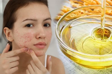 முகப்பருக்களால் அவதிப்படுகிறீர்களா? கவலை வேண்டாம் நல்லெண்ணெய் கொண்டு விரட்டி அடிக்கலாம்!