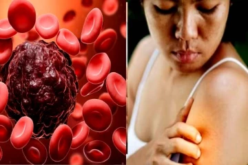இரத்தப் புற்றுநோய் ஆரம்பநிலை அறிகுறிகள் எப்படி இருக்கும் பார்த்துருகீங்களா?