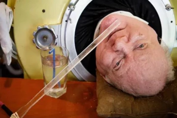 272 கிலோ இயந்திர நுரையீரலுடன் 70 ஆண்டுகள் வாழ்ந்து வந்த நபர் உயிரிழந்தார்!