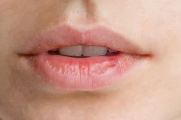 முக அழகை கெடுக்கும் உதடு வெடிப்பு - இந்த மருந்தை தினமும் வீட்டில் செய்யுங்கள்