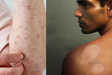 ඔබගේ සිරුරේ මෙවැනි ලප කැළැල් තිබෙනවාද..? එසේනම් වහාම මෙම අංකයට පණිවිඩයක් යොමු කරන්න..! සෞඛ්‍ය ප්‍රවර්ධන කාර්යාංශයෙන් අනතුරුදායක නිවේදනයක්..!