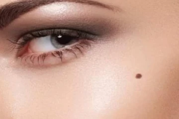 மச்சம் இருப்பது உங்களுக்கு பிடிக்கவில்லையா? இயற்கை முறையில் நீக்கிவிடலாம்