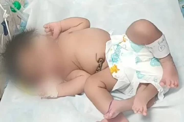 முதன் முதலாக நான்கு கால்களுடன் பிறந்த அதிசய குழந்தை! கால்களை அகற்ற போராடும் வைத்தியர்கள்