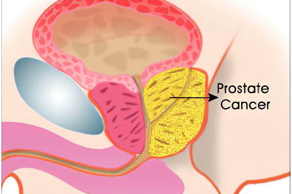 ஆண்களே... இந்த இடத்தில் இப்படி அறிகுறி இருந்தால் புற்றுநோய் தாக்கியிருக்கும் - உடனே இதை செய்யுங்கள் | Cancer Symptoms In Men