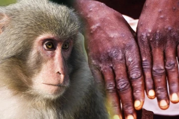 வேகமாக பரவிவரும் குரங்கம்மை!  உலகெங்கும் 11 நாடுகளில் பரவல்.. அச்சத்தில் சர்வதேசம்