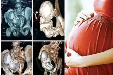 35 ஆண்டுகள் கர்ப்பம்! 73 வயதில் குழந்தை பெற்றெடுத்த மூதாட்டி.. தலைசுற்ற வைக்கும் தகவல்