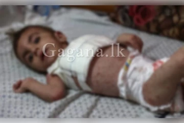 ගාසා තීරයේ ළමුන් අතර භයානක සමේ රෝගයක්..(VIDEO)