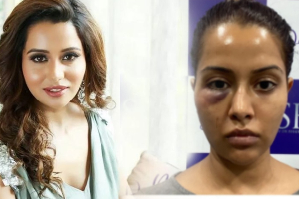 எப்படி இருந்த என் முகம் இப்படி ஆயிடுச்சு : நடிகை ரைசா புகைப்படத்தால் பரபரப்பு! | Cinema