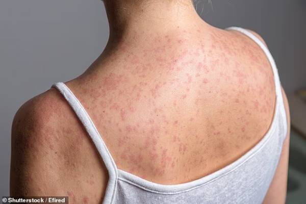 measles spreading in north london 60 children affected