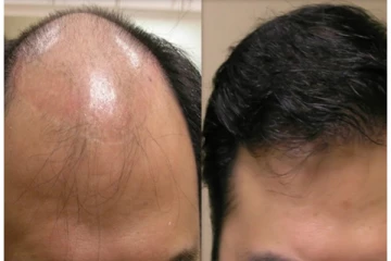 சொட்டை தலையிலும் முடி வளரும்!