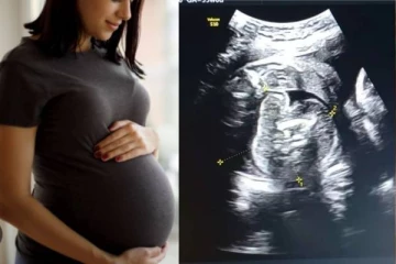 கர்ப்பிணியின் வயிற்றில் உள்ள குழந்தைக்குள் வளரும் கரு - மிரண்ட மருத்துவர்கள்!