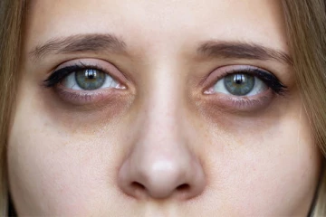 இந்த 5 பொருள் போதும்; வீட்டில் இருந்தப்படியே கருவளையத்தை நீக்கலாம் தெரியுமா?