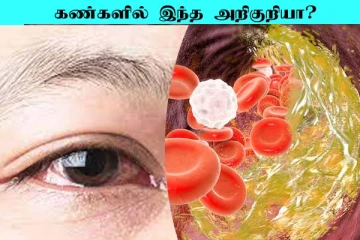 உங்க கண்ணில் இந்த அறிகுறிகள் தெரியுதா? கெட்ட கொலஸ்ட்ரால் அதிகம் இருக்கும் ஜாக்கிரதை