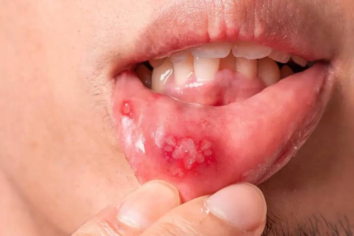 வாய்ப்புண்கள் வர காரணம் என்ன? இதற்கான வீட்டு வைத்தியங்கள் என்ன? | Mouth Ulcers Causes Symptoms Home Remedies