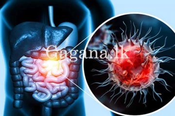 පිළිකා රෝගීන් ගැන සෞඛ්‍ය ලේකම් ගෙන් අනාවරණයක්.