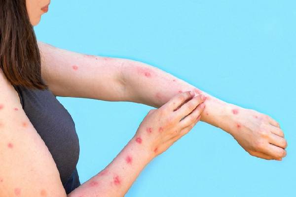 Red Spots on Skin: சருமத்தில் தோன்றும் சிவப்பு புள்ளிகள் ஆபத்தானதா? மருத்துவ விளக்கம் | Whats The Reson Behaind Red Spots On Skin