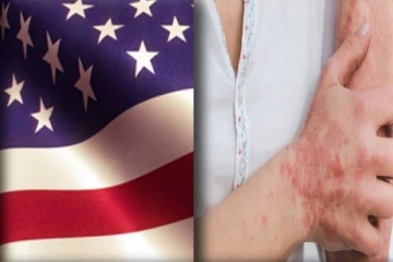 அமெரிக்காவில் அதிகரிக்கும் குரங்கு அம்மை பாதிப்பு- உலக செய்திகள்