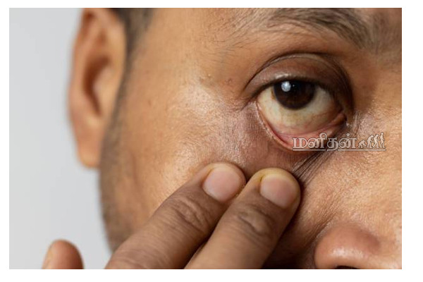 கருப்பு பூஞ்சை நோய் எதனால் ஏற்படுகிறது? அறிகுறியும் தடுக்கும் வழிமுறைகளும்; | Black Fungus Symptoms In Tamil