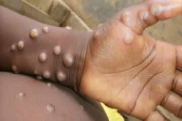 கனடாவிலும் பரவியது குரங்கு அம்மை நோய்